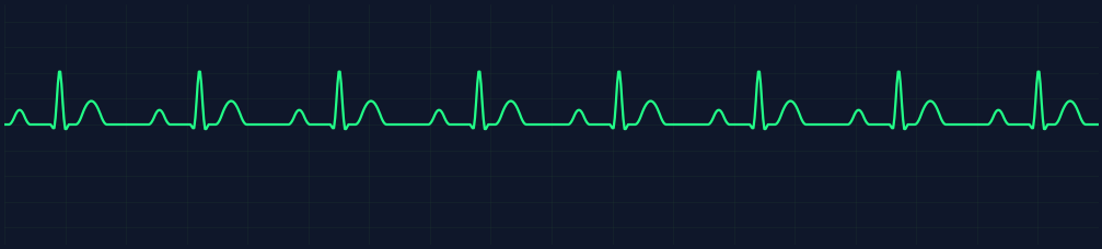 Sinus Brady