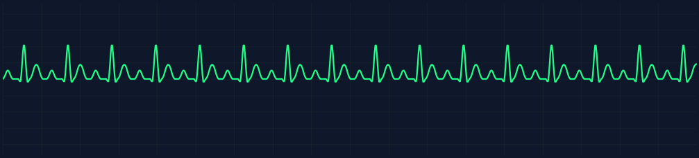 Sinus Tach